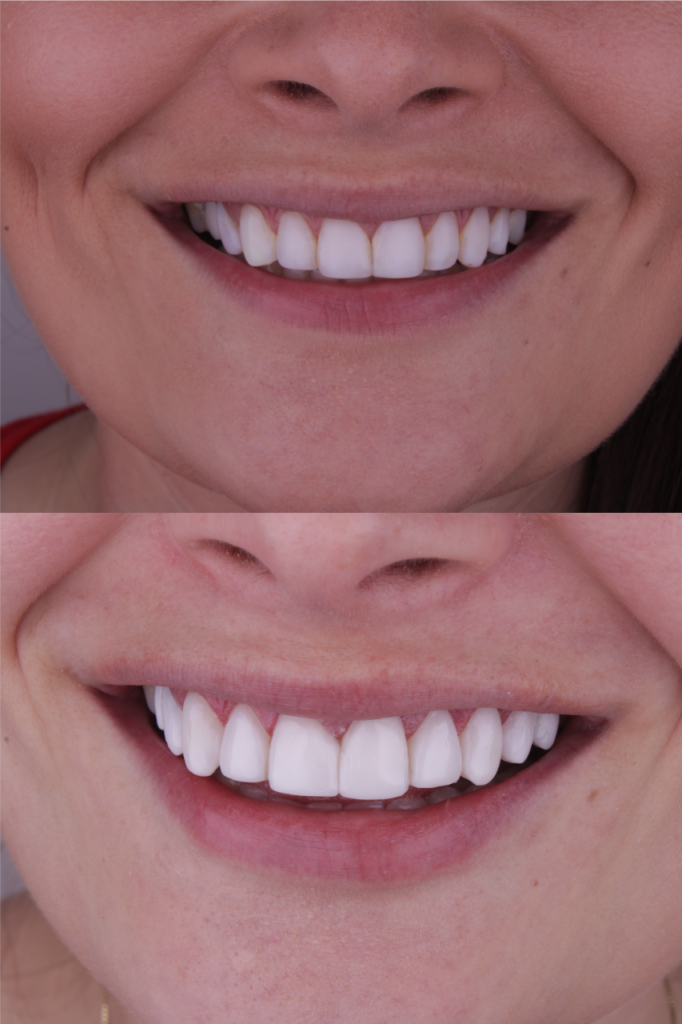 Andreola Odontologia Integrada - Clínica Odontológica em Caxias do Sul - Implantes Dentários - Lentes de Contato Dental - Tratamento de Canal - Odontologia Estética - Ortodontia - Harmonização Facial