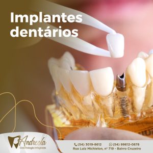 Andreola Odontologia Integrada - Clínica Odontológica em Caxias do Sul - Implantes Dentários - Lentes de Contato Dental - Tratamento de Canal - Odontologia Estética - Ortodontia - Harmonização Facial