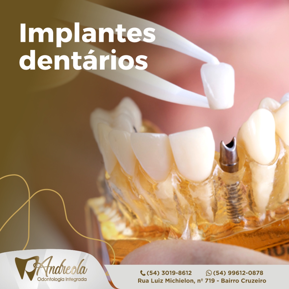 Andreola Odontologia Integrada - Clínica Odontológica em Caxias do Sul - Implantes Dentários - Lentes de Contato Dental - Tratamento de Canal - Odontologia Estética - Ortodontia - Harmonização Facial